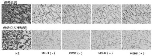 Compound amplification system and kit for MSI (microsatellite instability) gene mutation detection