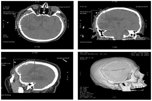 Bioabsorbable bone repair material and its use and manufacturing method