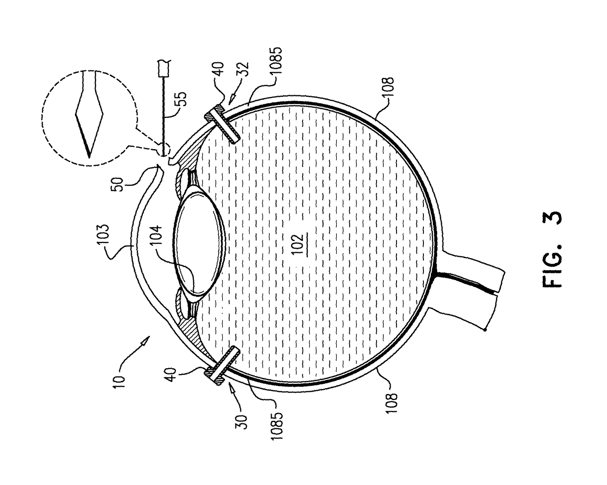 Surgical techniques for implantation of a retinal implant