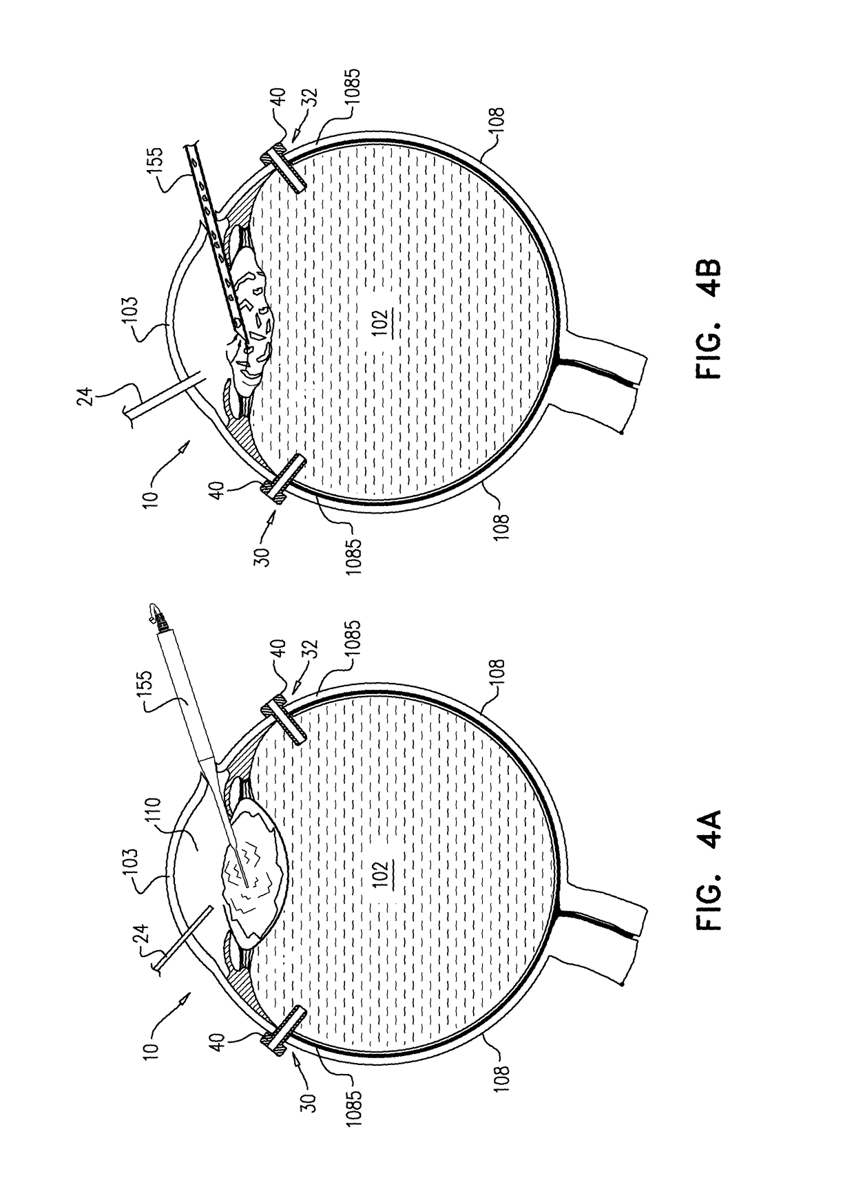 Surgical techniques for implantation of a retinal implant