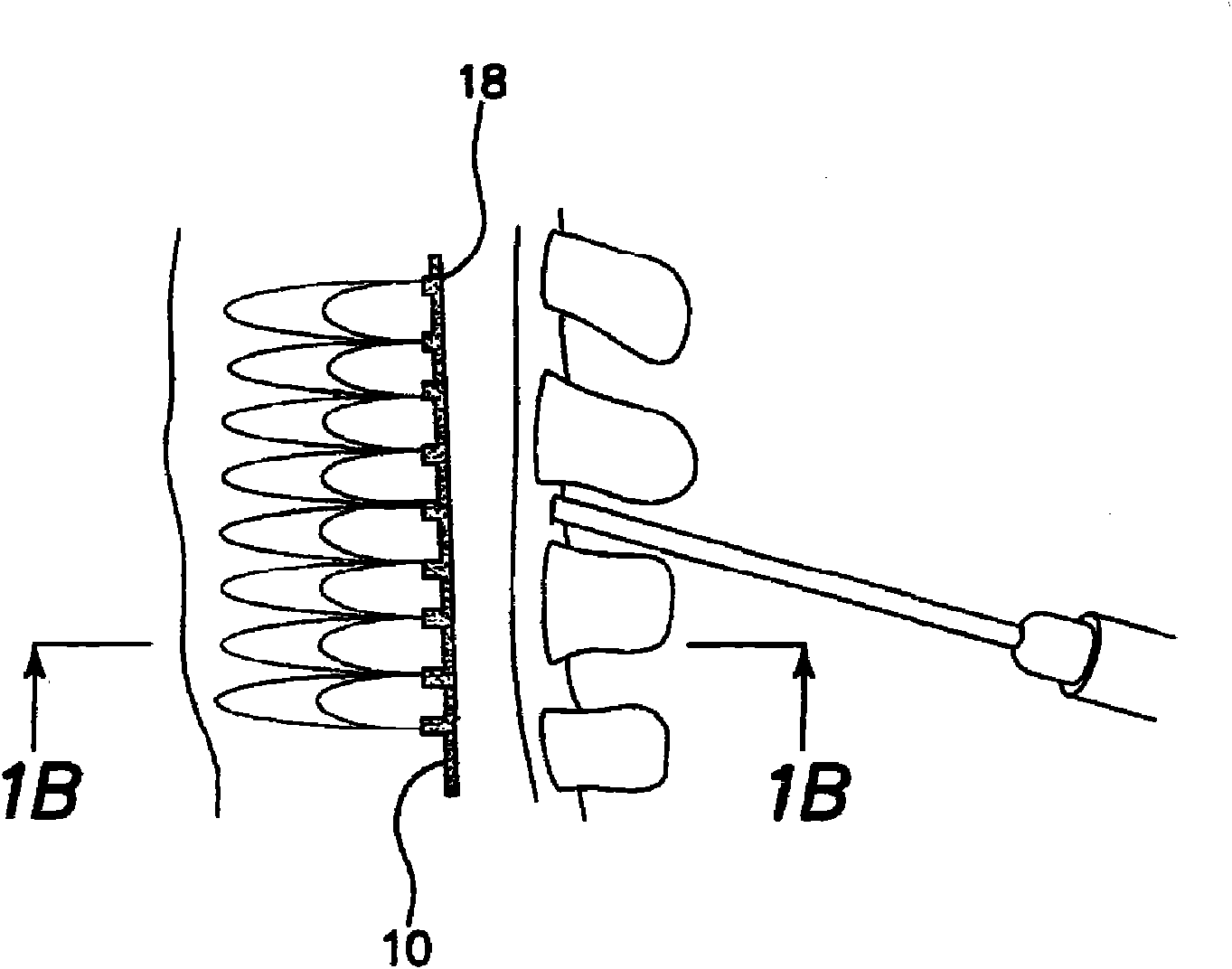 An apparatus and method for in vivo intracellular transfection of gene, sirna, shrna vectors, and other biomedical diagnostic and therapeutic drugs and molecules for the treatment of arthritis and oth