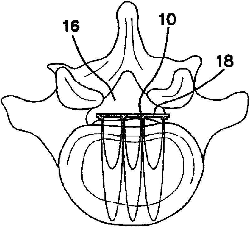 An apparatus and method for in vivo intracellular transfection of gene, sirna, shrna vectors, and other biomedical diagnostic and therapeutic drugs and molecules for the treatment of arthritis and oth