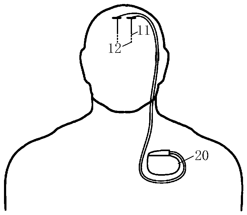 Implanted nerve stimulator and implanted nerve stimulation system with temperature measurement function