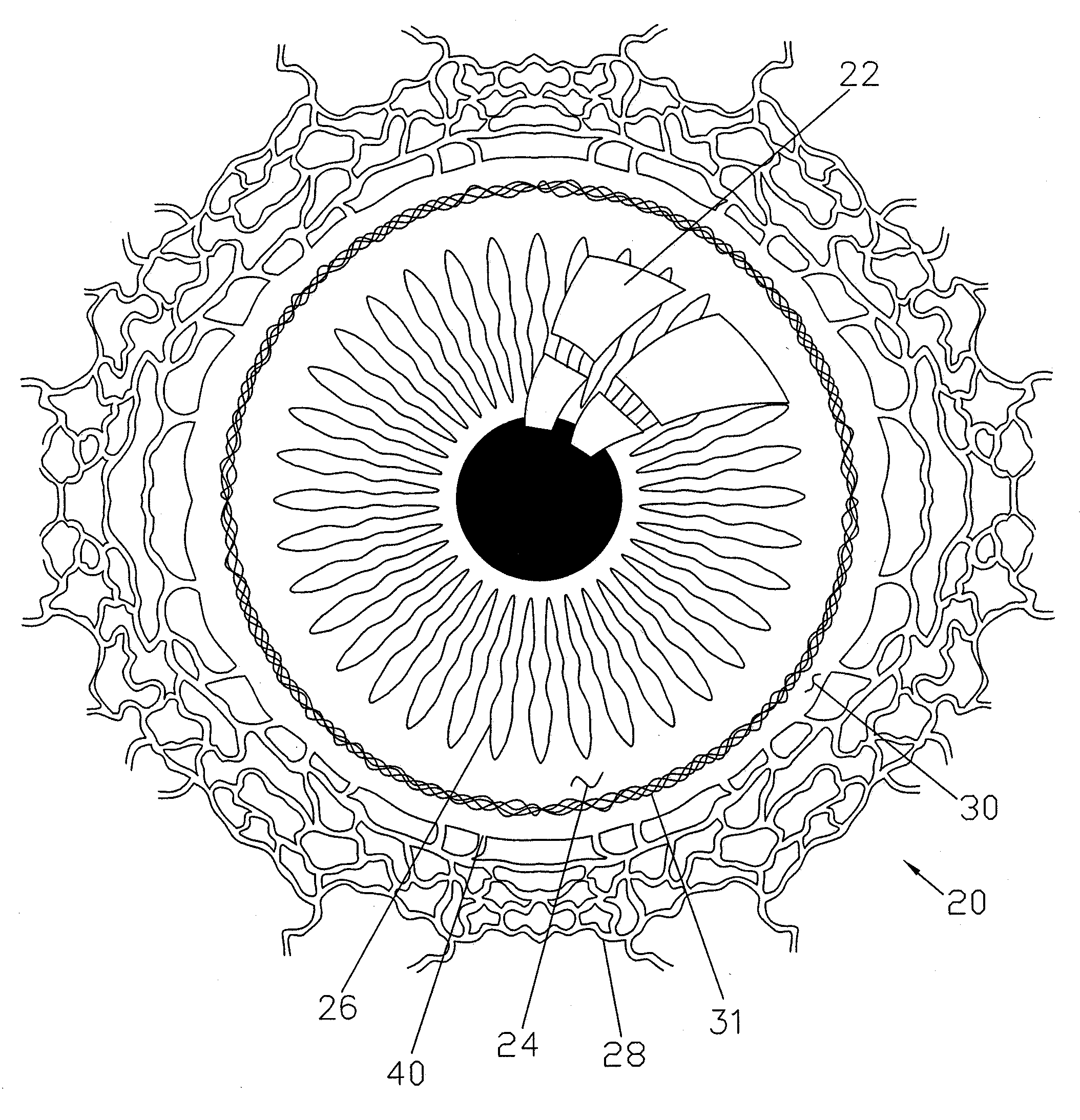 Ocular Implants