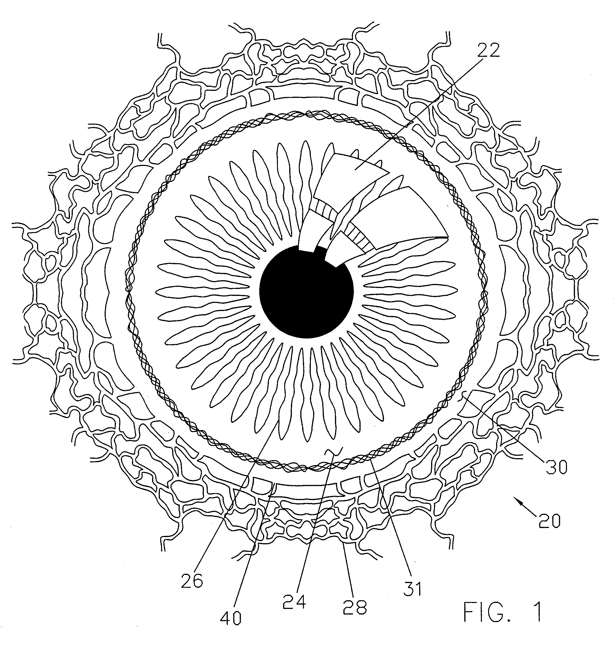 Ocular Implants