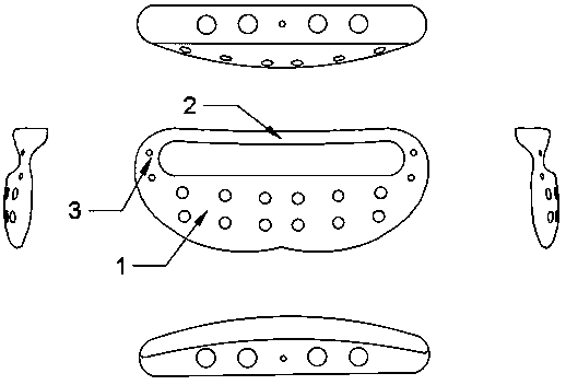 Pubic symphysis dissection type vertical locking bone plate