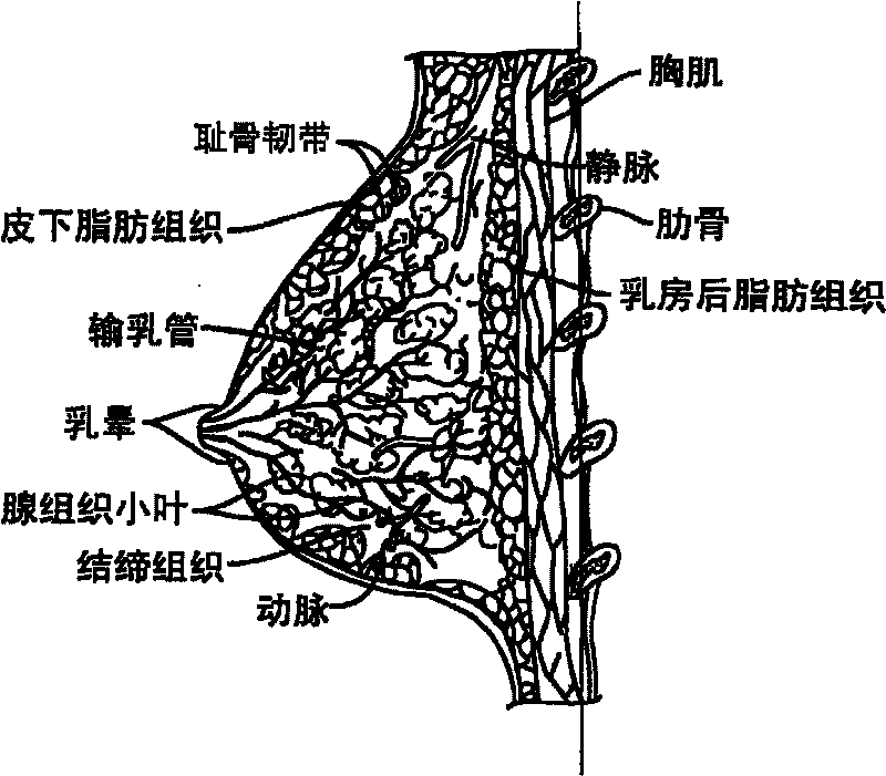 Thermotherapy method for treatment and prevention of breast cancer and cancer in other organs