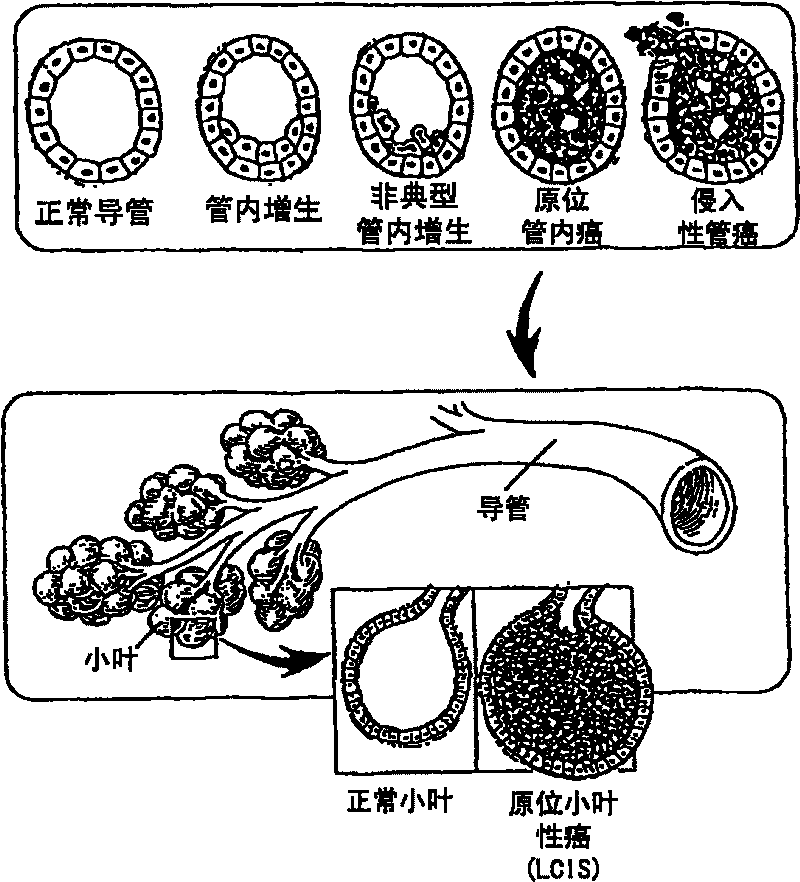 Thermotherapy method for treatment and prevention of breast cancer and cancer in other organs