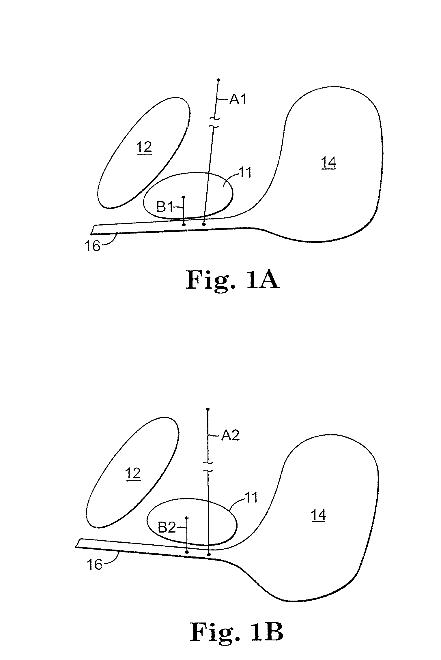 Implant Inserted Without Bone Anchors For Treatment of Urge Incontinence