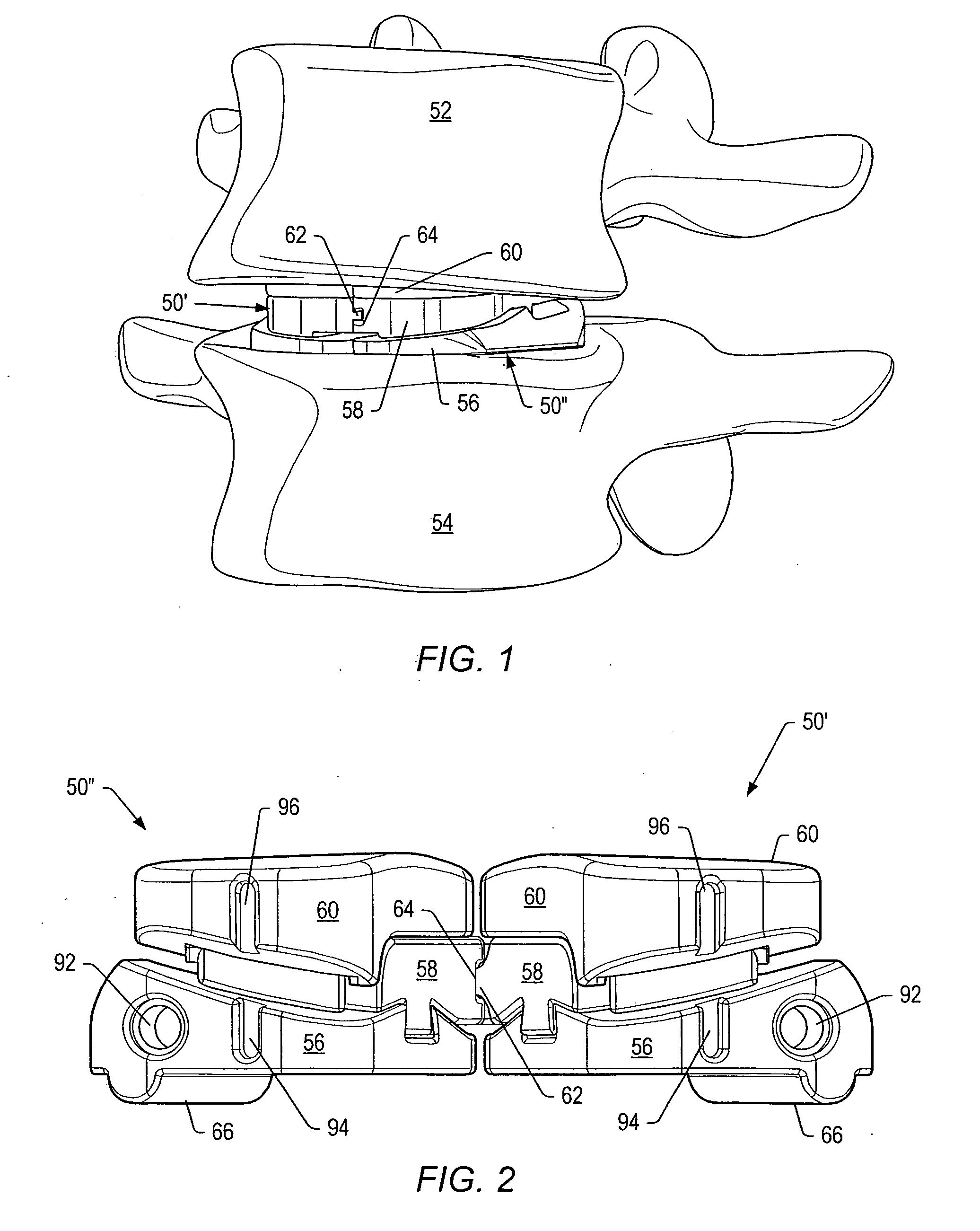 Artificial functional spinal unit system and method for use