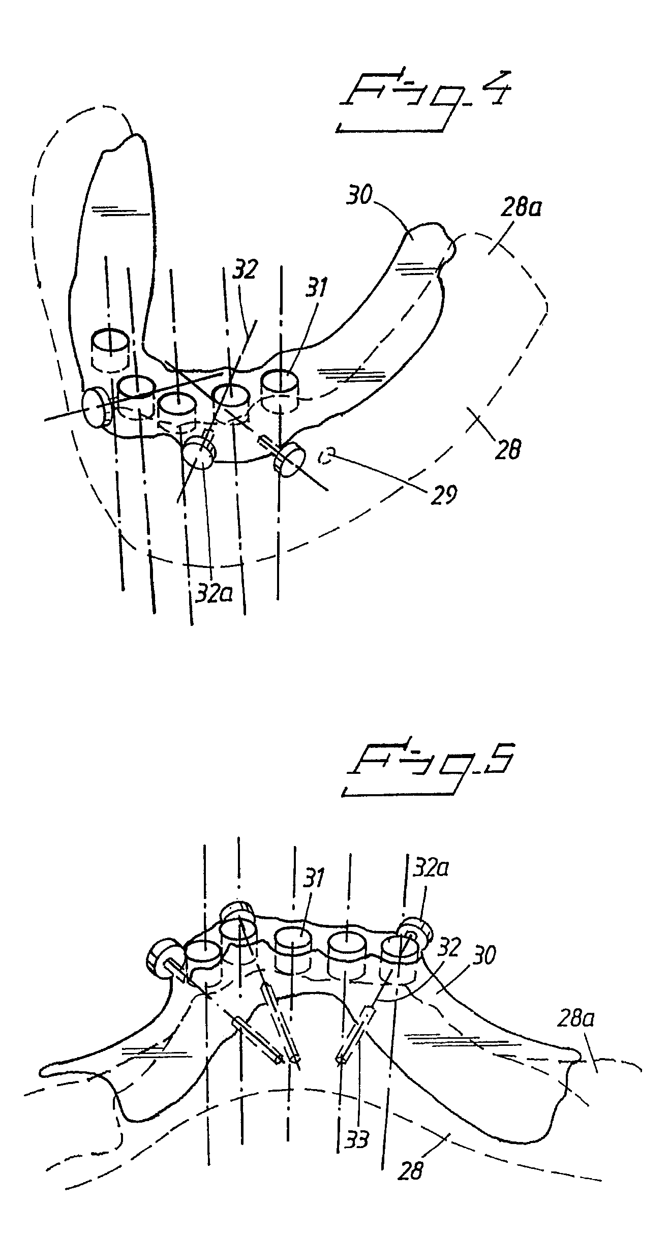 Arrangement and device for using a template to form holes for implants in bone, preferably jaw bone