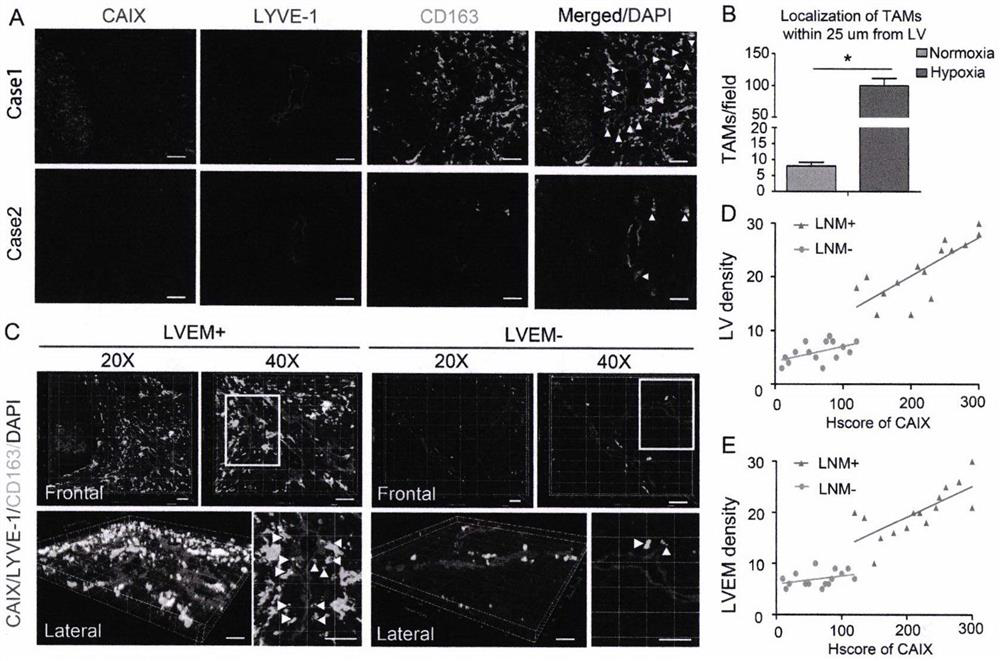 Detection and application of novel cervical cancer metastasis marker