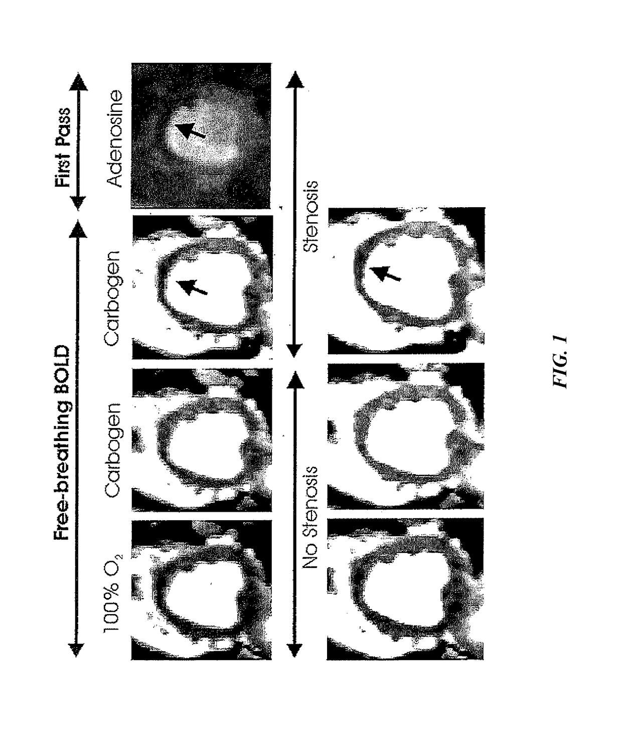 Assessment of coronary heart disease with carbon dioxide