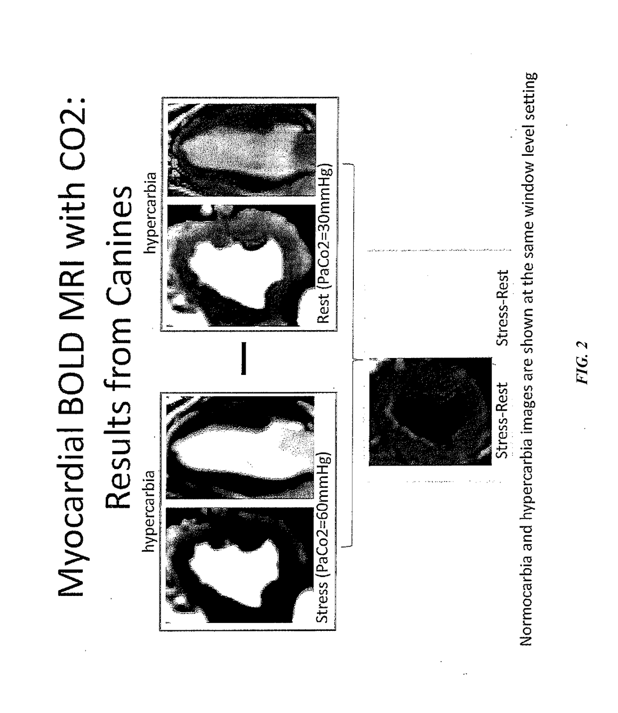 Assessment of coronary heart disease with carbon dioxide