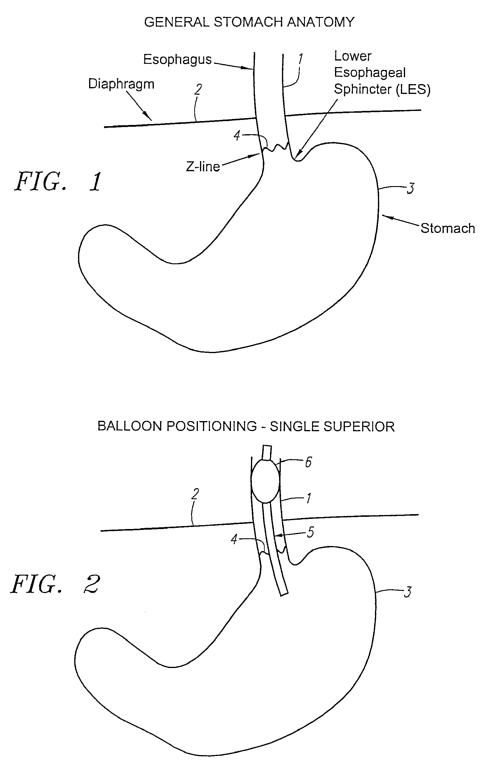 Methods and apparatus for treatment of obesity