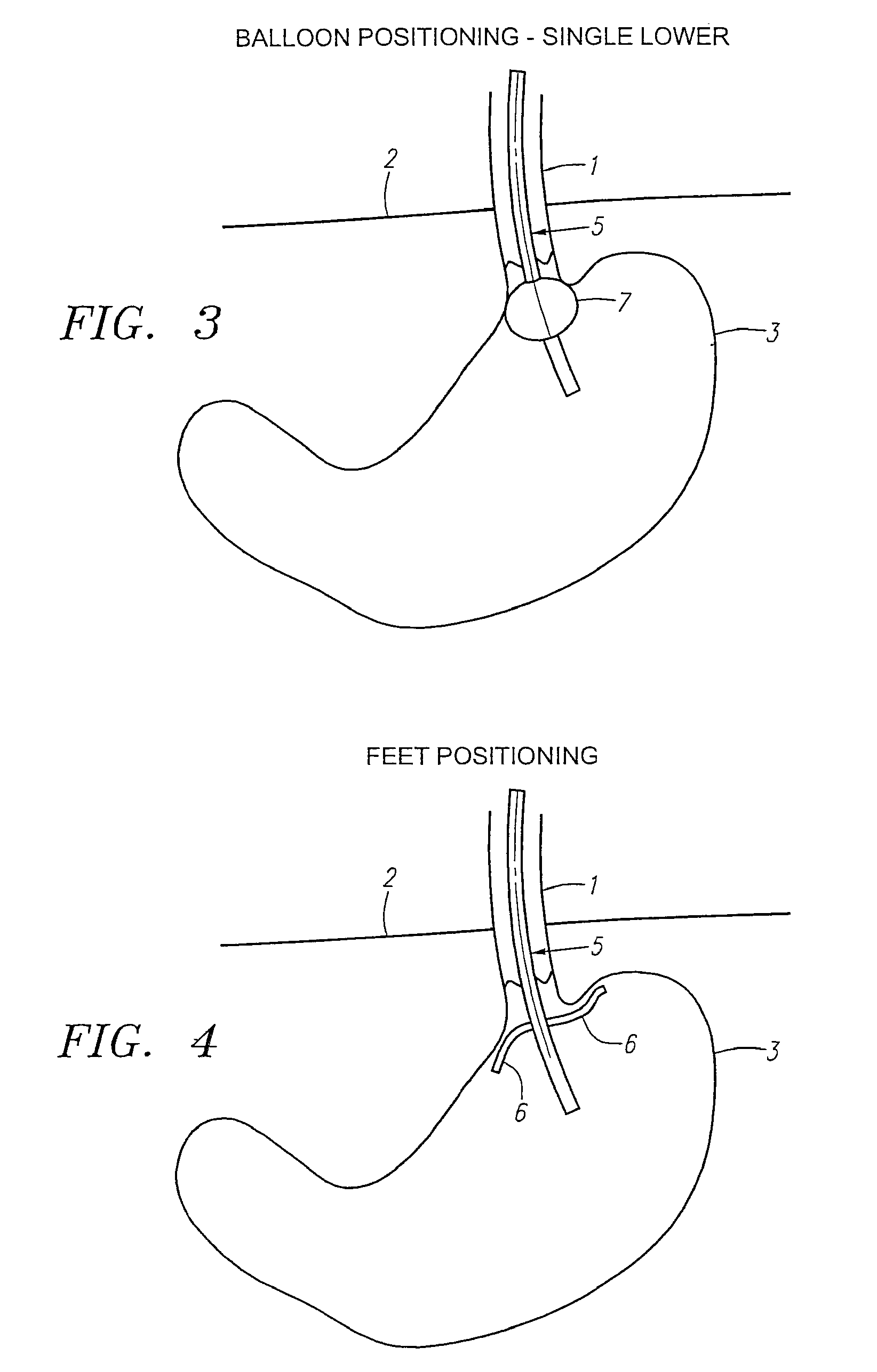 Methods and apparatus for treatment of obesity