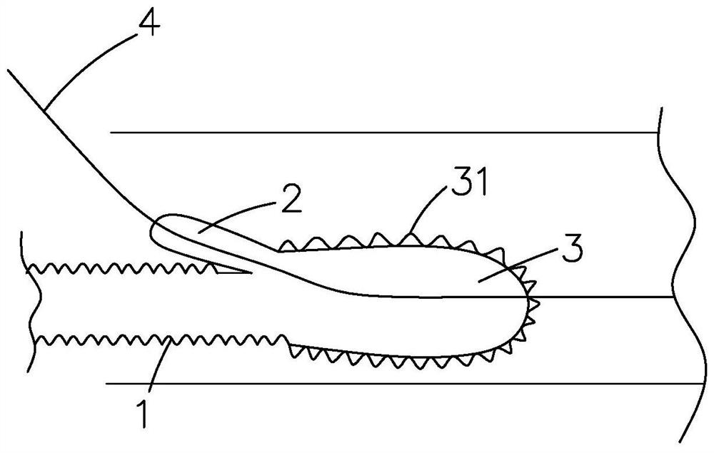 A kind of compound intraoperative stent system and using method thereof