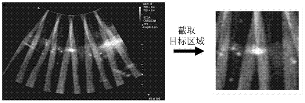 B ultrasonic image-based space-time quantization monitoring system and method for realizing ultrasonic cavitation during HIFU (High Intensity Focused Ultrasound) treatment