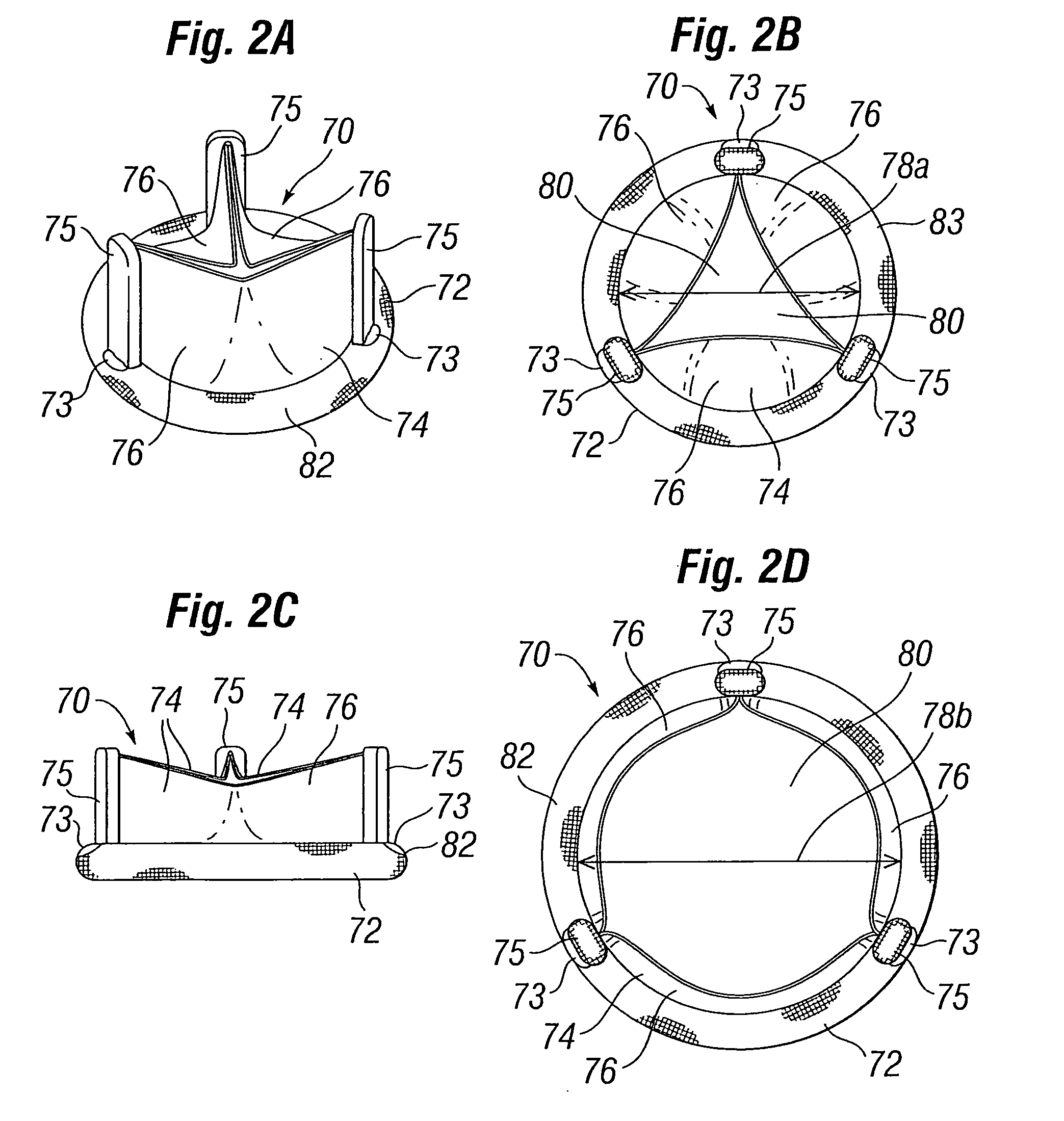 Prosthetic heart valve configured to receive a percutaneous prosthetic heart valve implantation