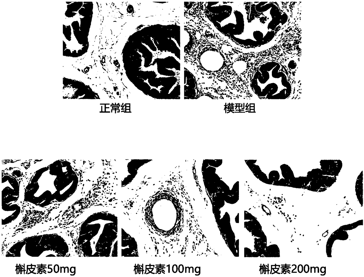 Application of quercetin in preparation of drug for treating CP (chronic prostatitis)