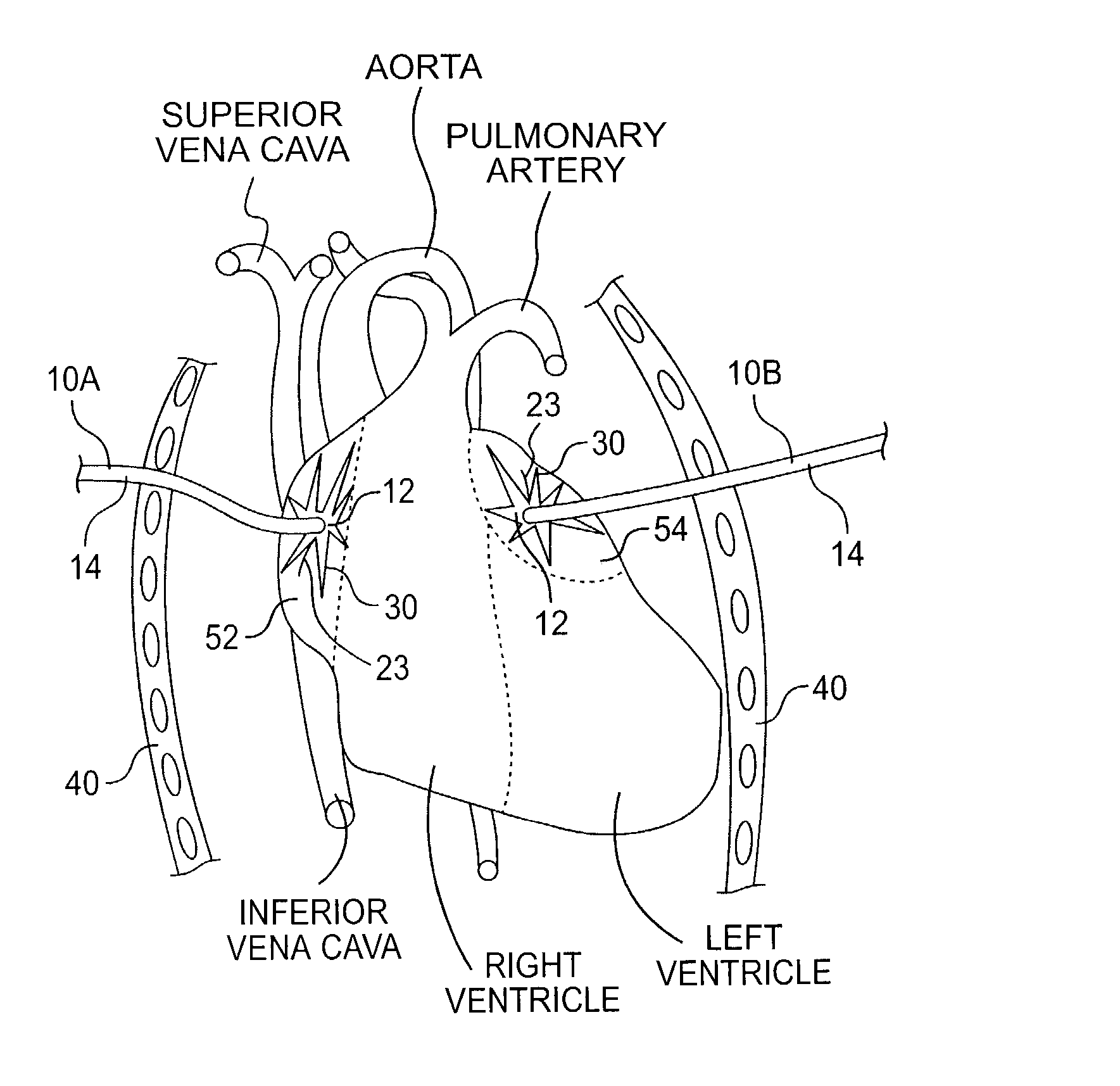 Implantable device for treating atrial fibrillation and method of using same