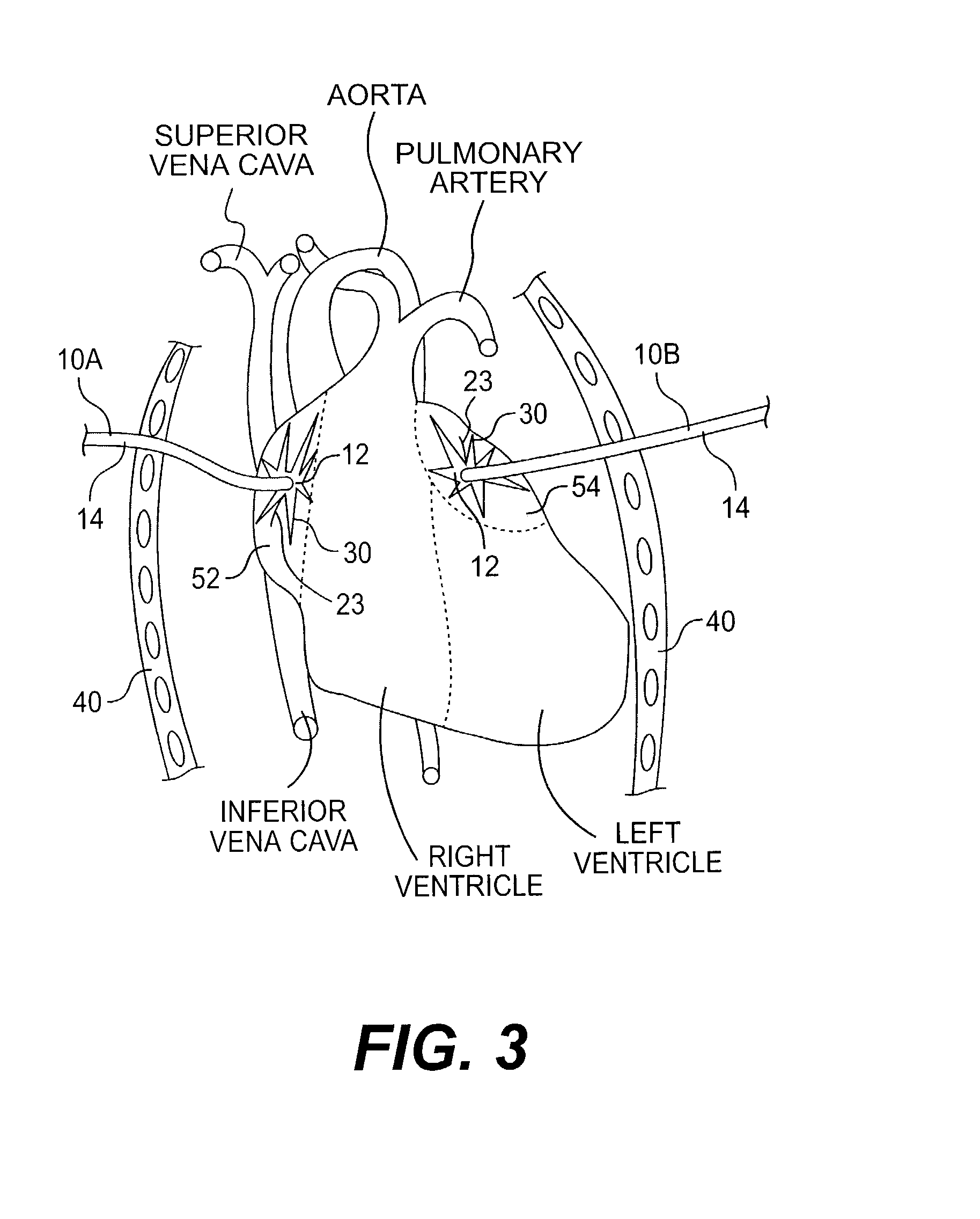 Implantable device for treating atrial fibrillation and method of using same