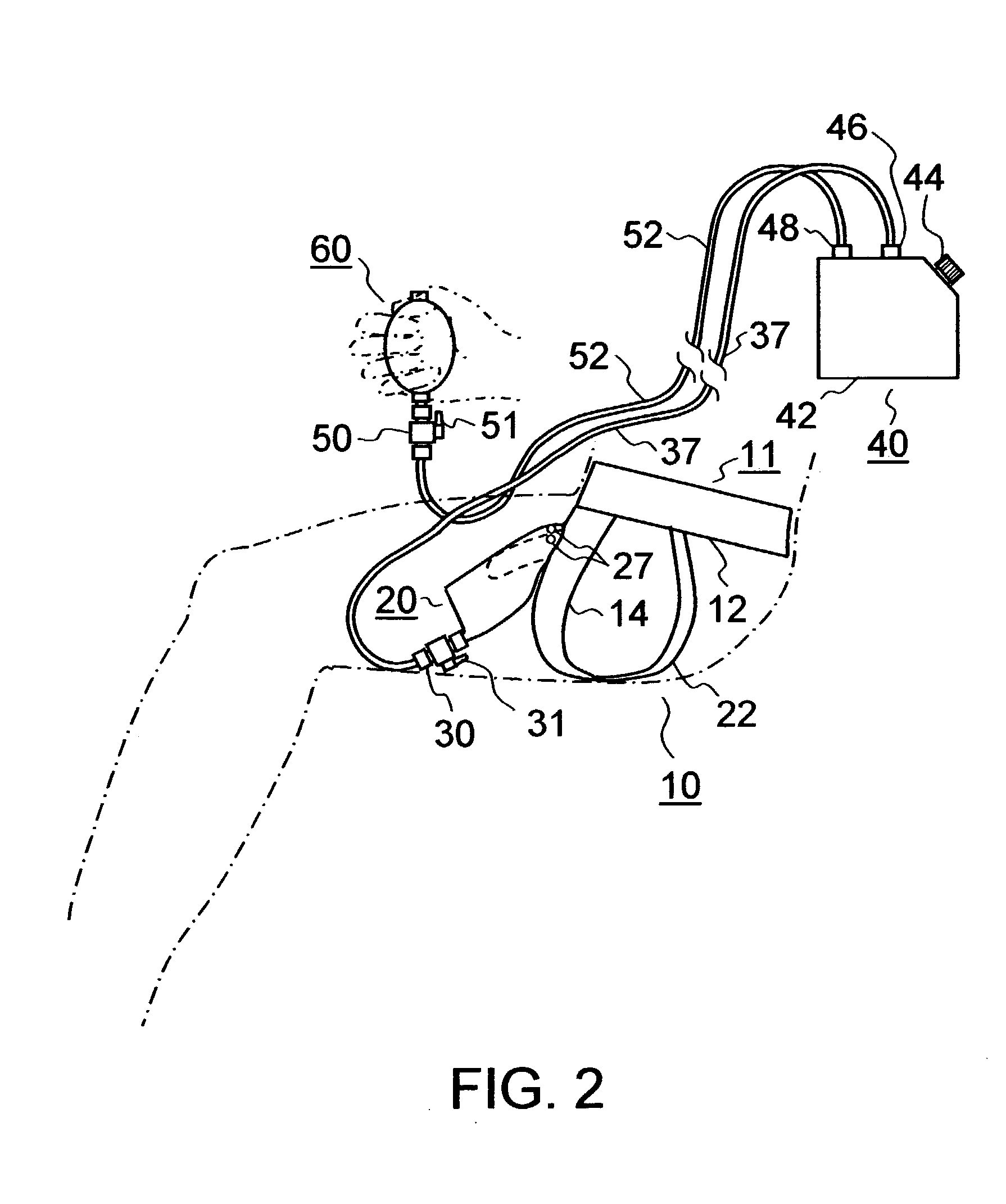 Urine collection system for males utilizing a flexible external catheter and vacuum assistance