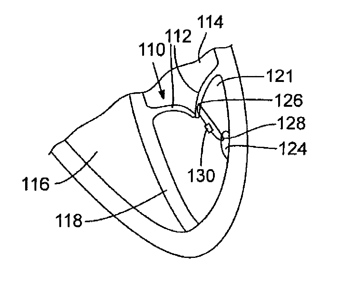 Method and apparatus for repairing or replacing chordae tendinae