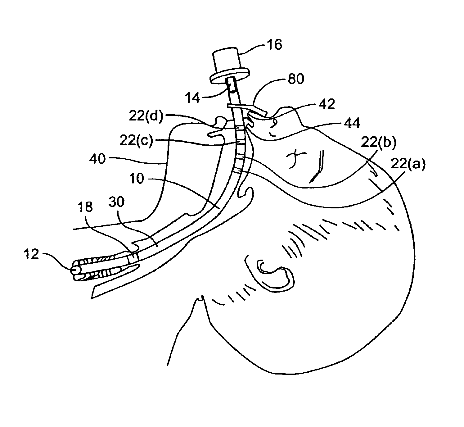 Endotracheal tube