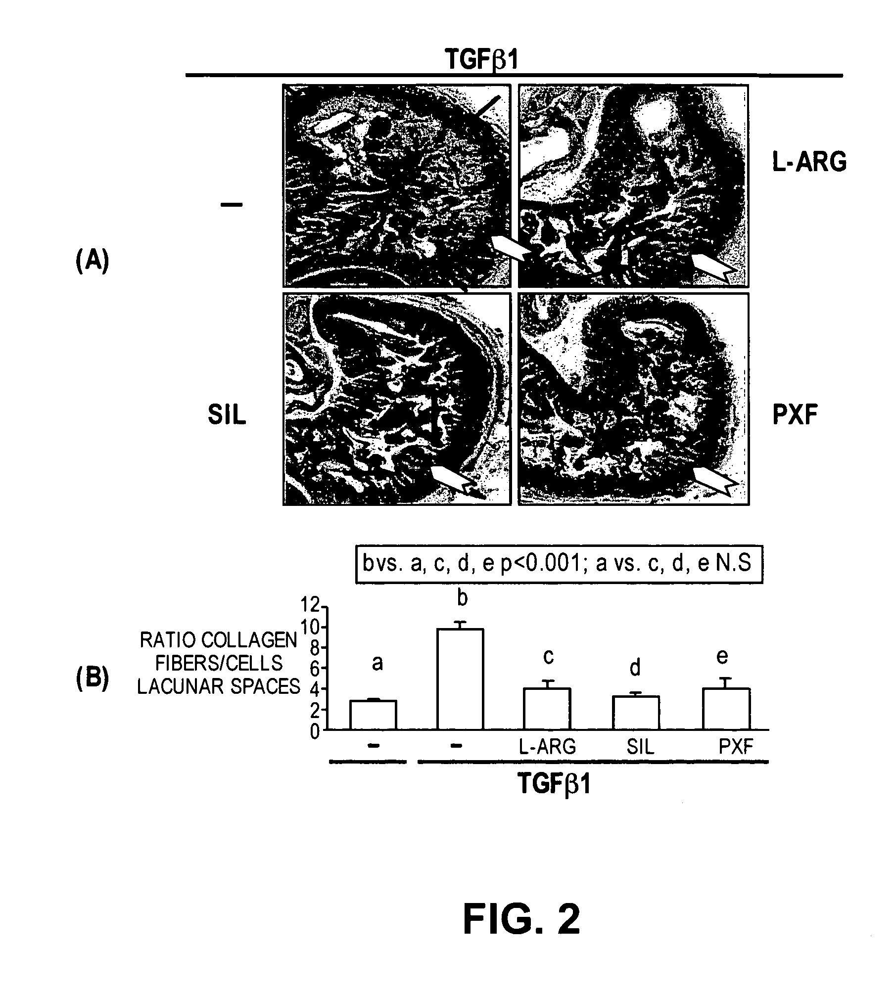 Methods of use of inhibitors of phosphodiesterases and modulators of nitric oxide, reactive oxygen species, and metalloproteinases in the treatment of peyronie's disease, arteriosclerosis and other fibrotic diseases