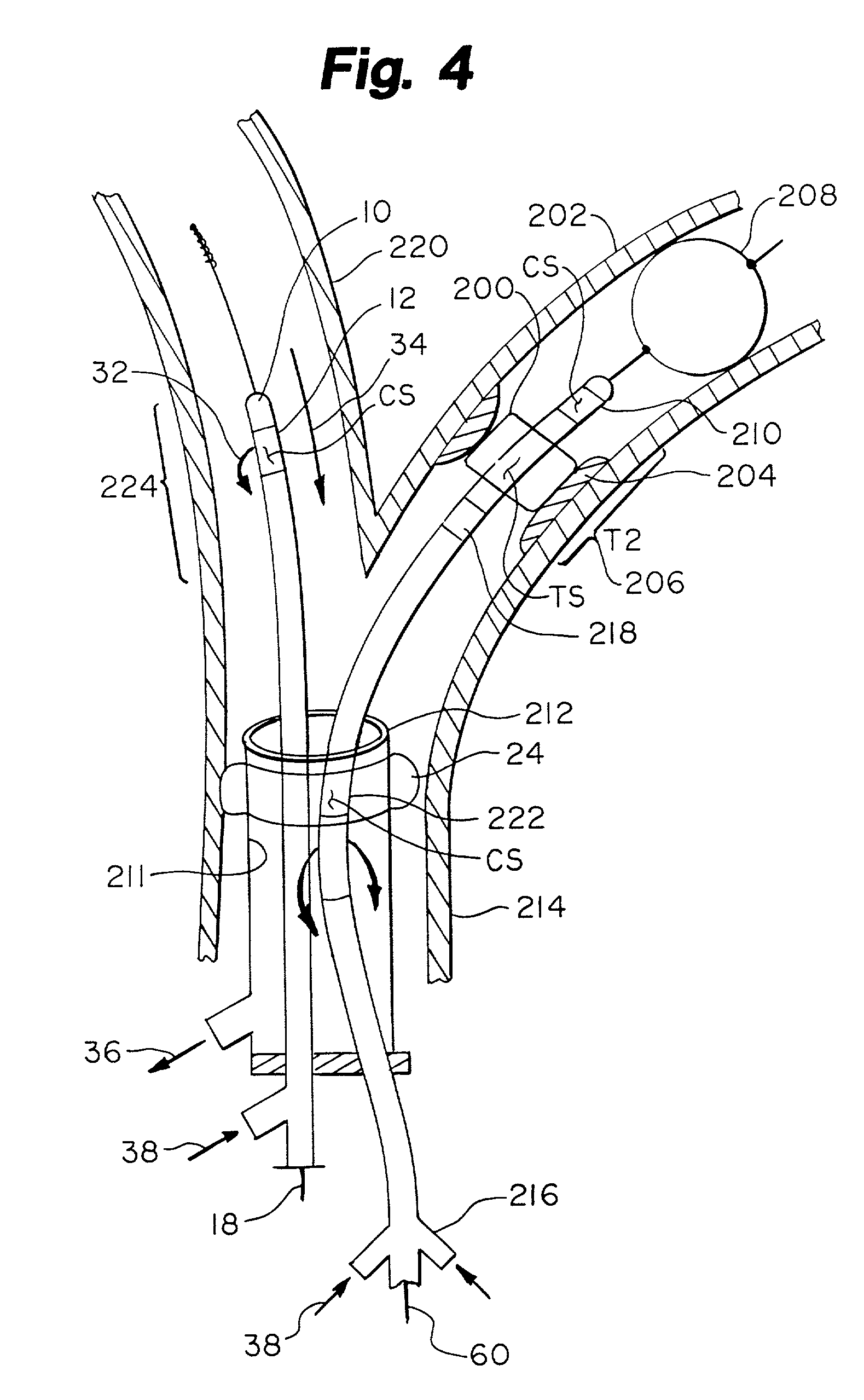 Fluidic interventional device and method of distal protection