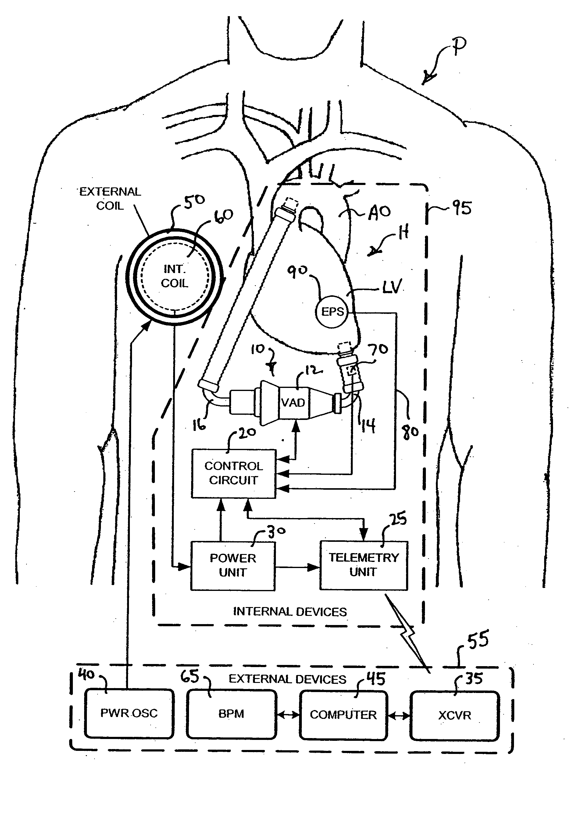 Feedback control of ventricular assist devices