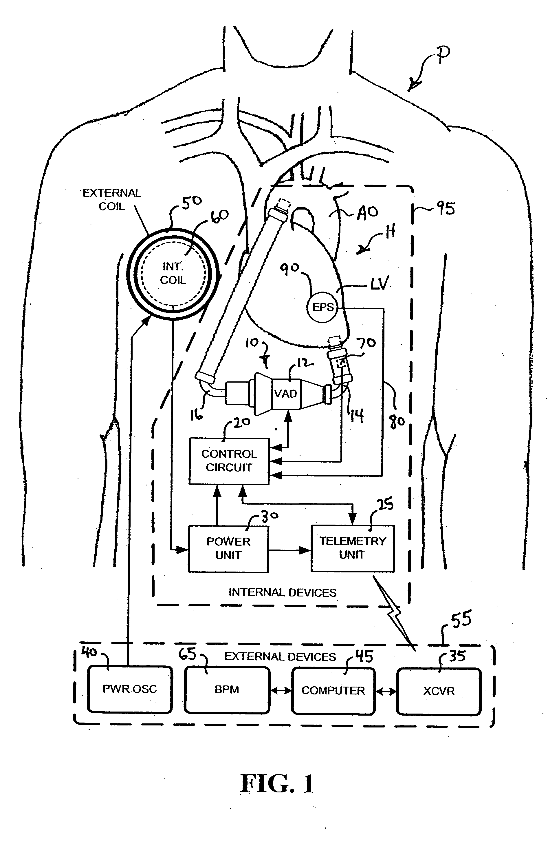 Feedback control of ventricular assist devices