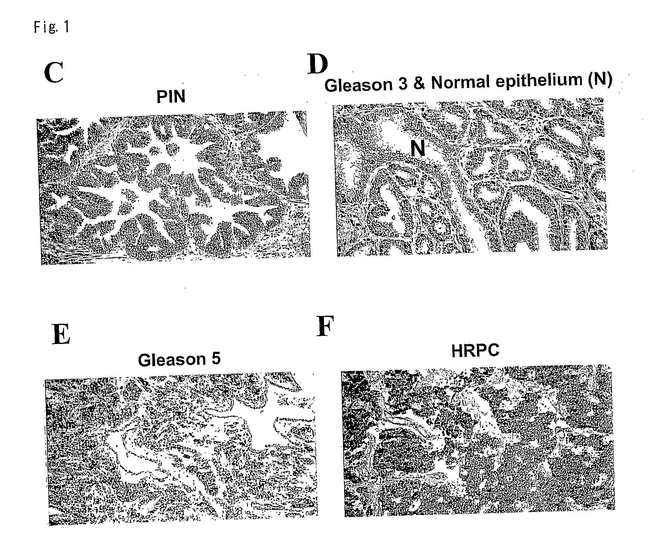 PKIB and NAALADL2 for Target Genes of Prostate Cancer Therapy and Diagnosis