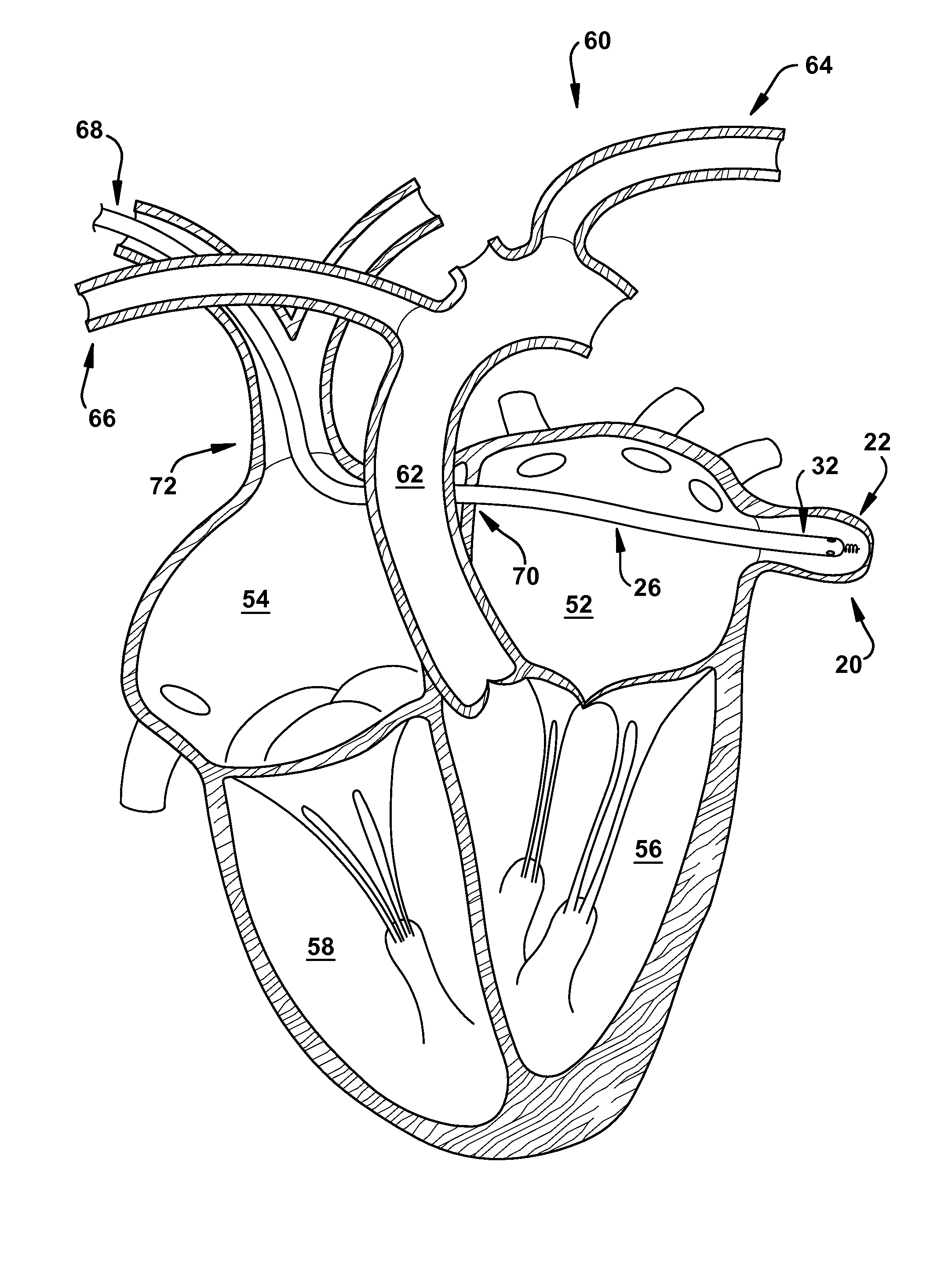 Method for increasing blood flow in or about a cardiac or other vascular or prosthetic structure to prevent thrombosis