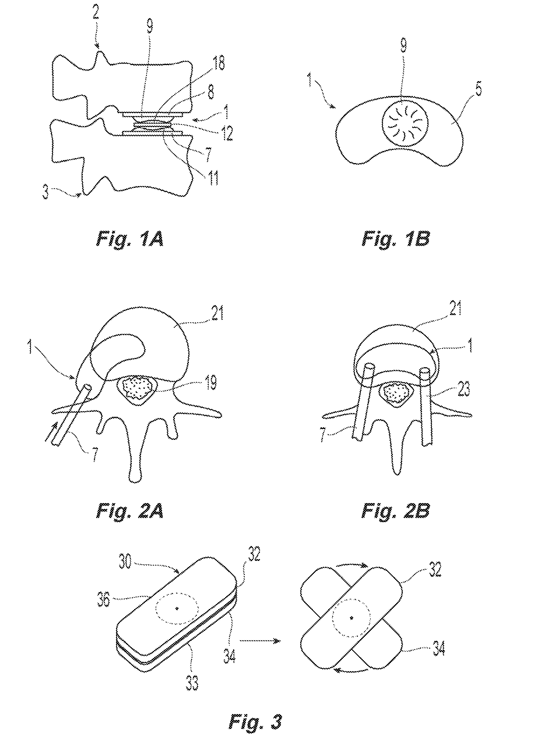 Posterior prosthetic spinal disc replacement and methods thereof
