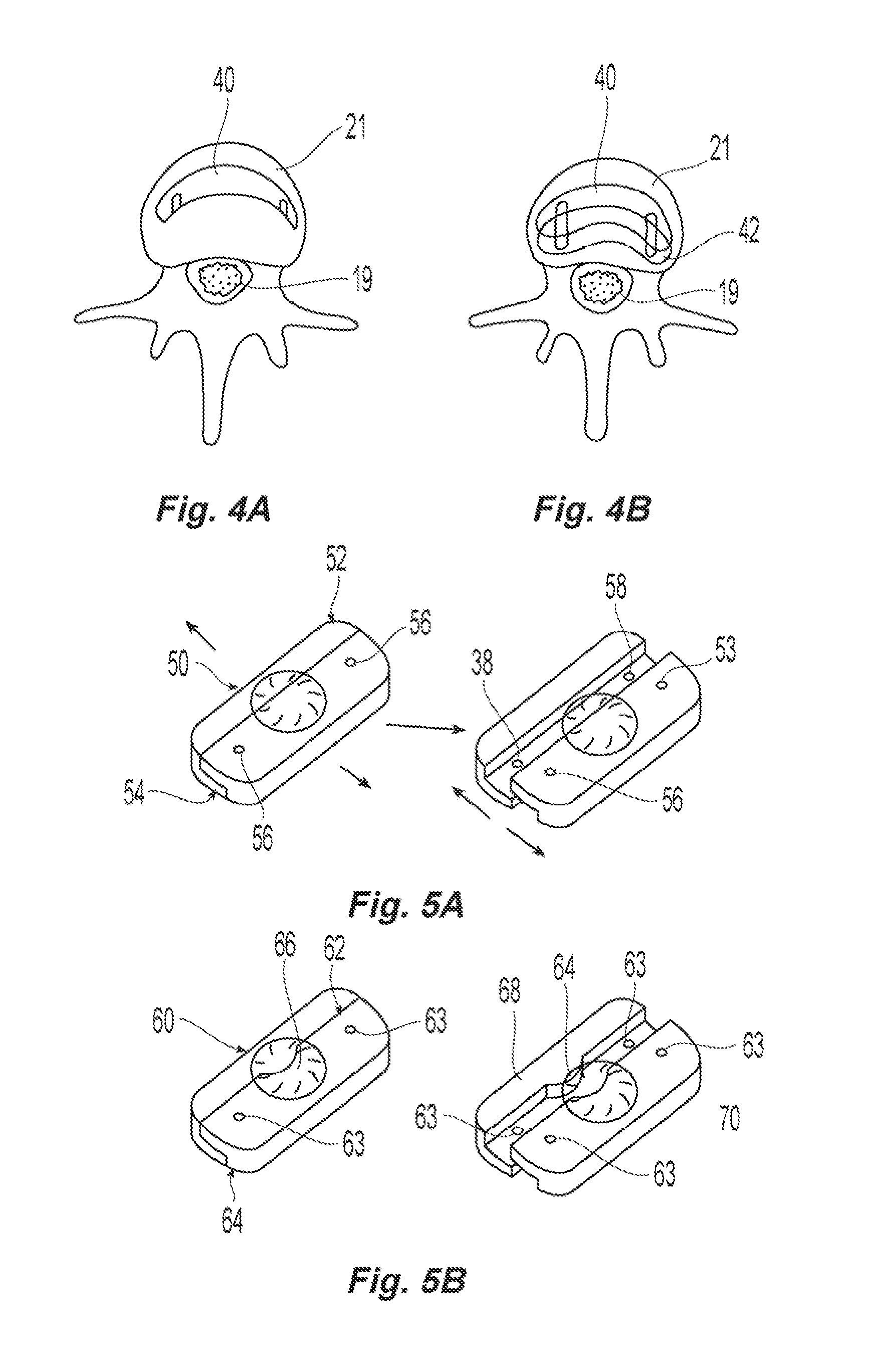 Posterior prosthetic spinal disc replacement and methods thereof