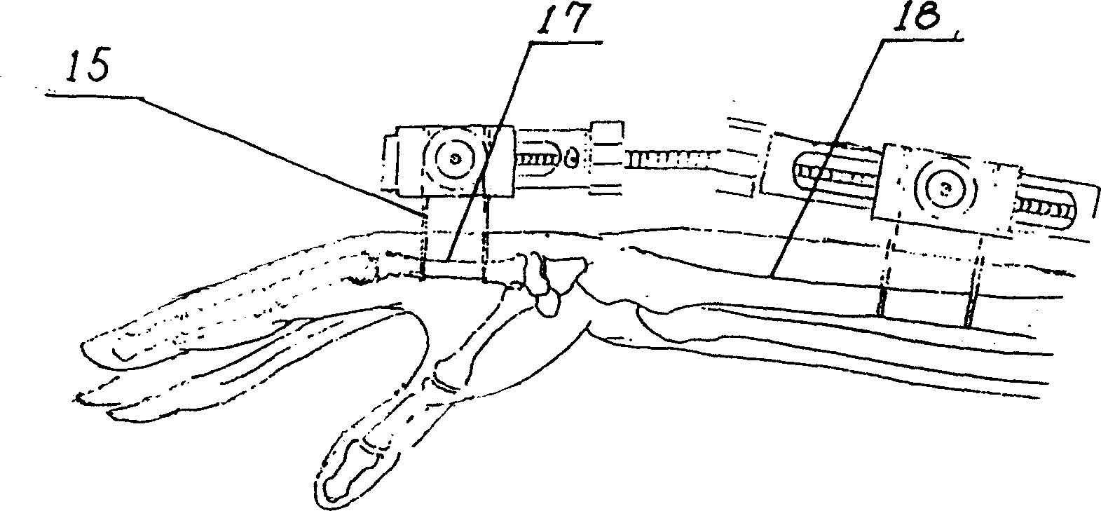 External fixer for radius distal fracture