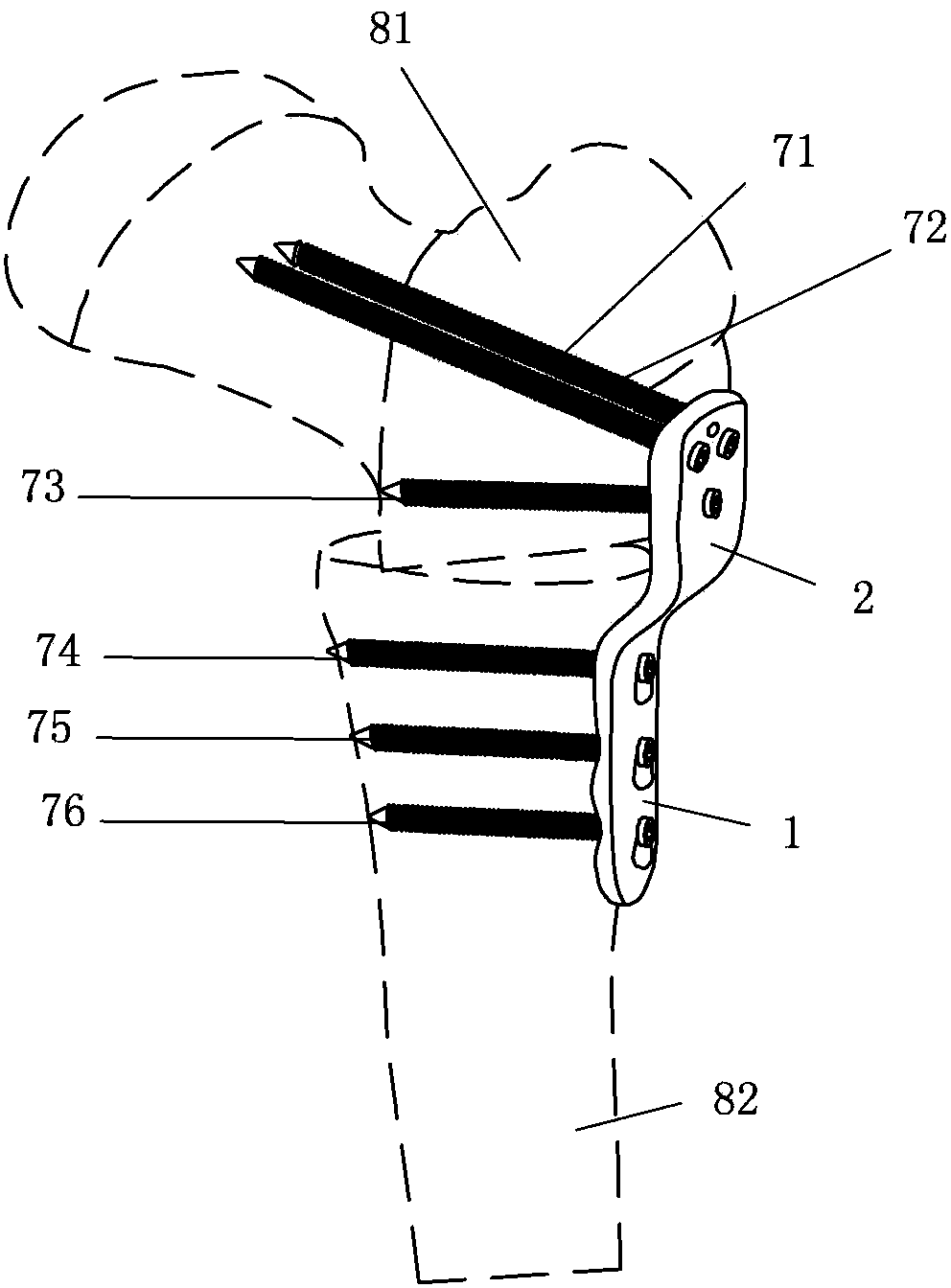 Locking plate for infantile osteotomy