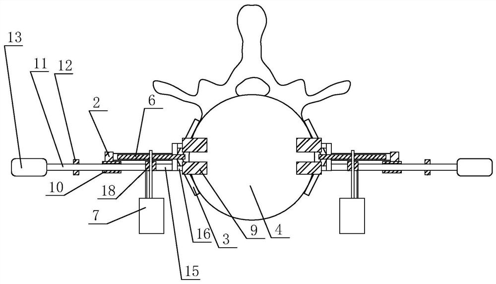 Vertebra opposite grooving device