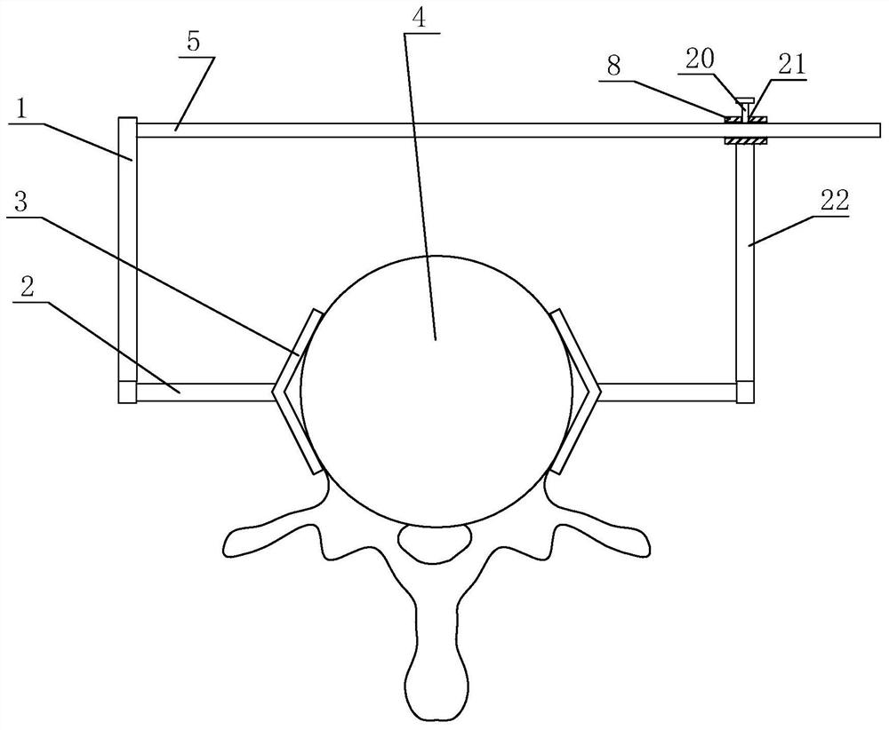 Vertebra opposite grooving device