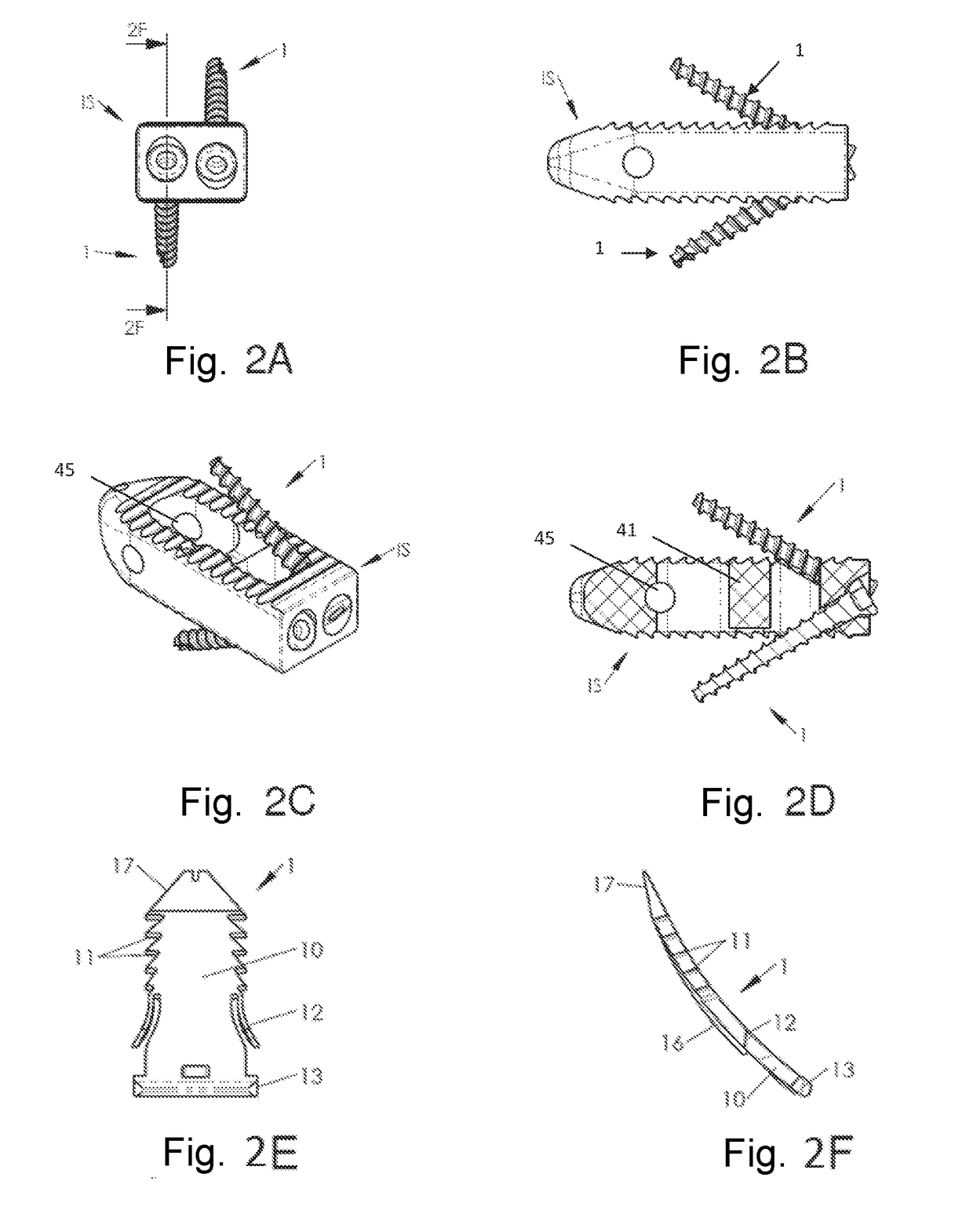 System of spinal arthodesis implants