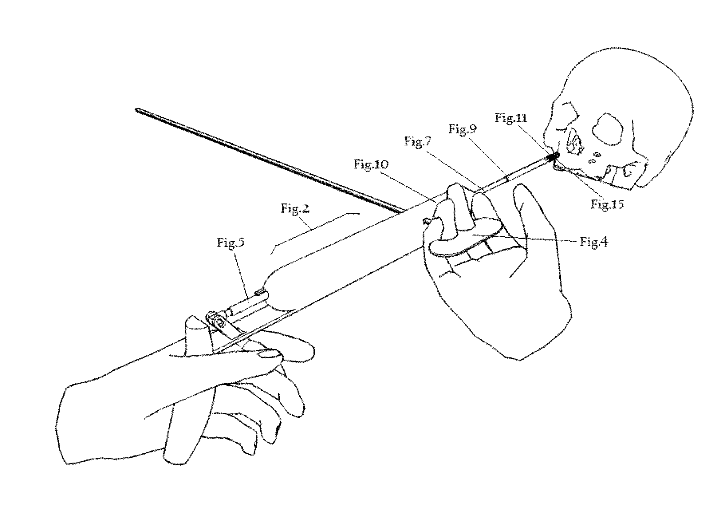 Sealing holes in bony cranial anatomy using custom fabricated inserts