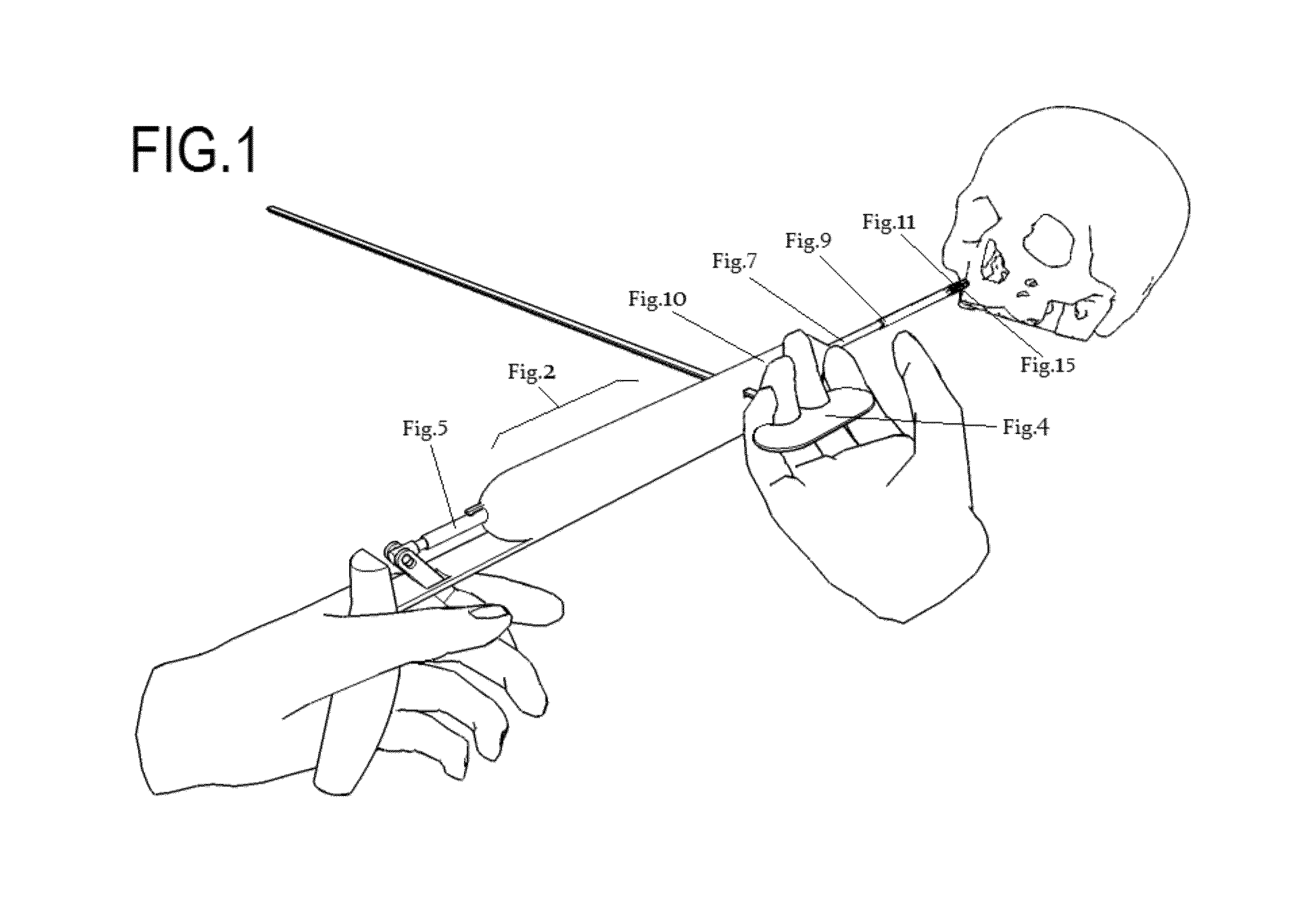 Sealing holes in bony cranial anatomy using custom fabricated inserts