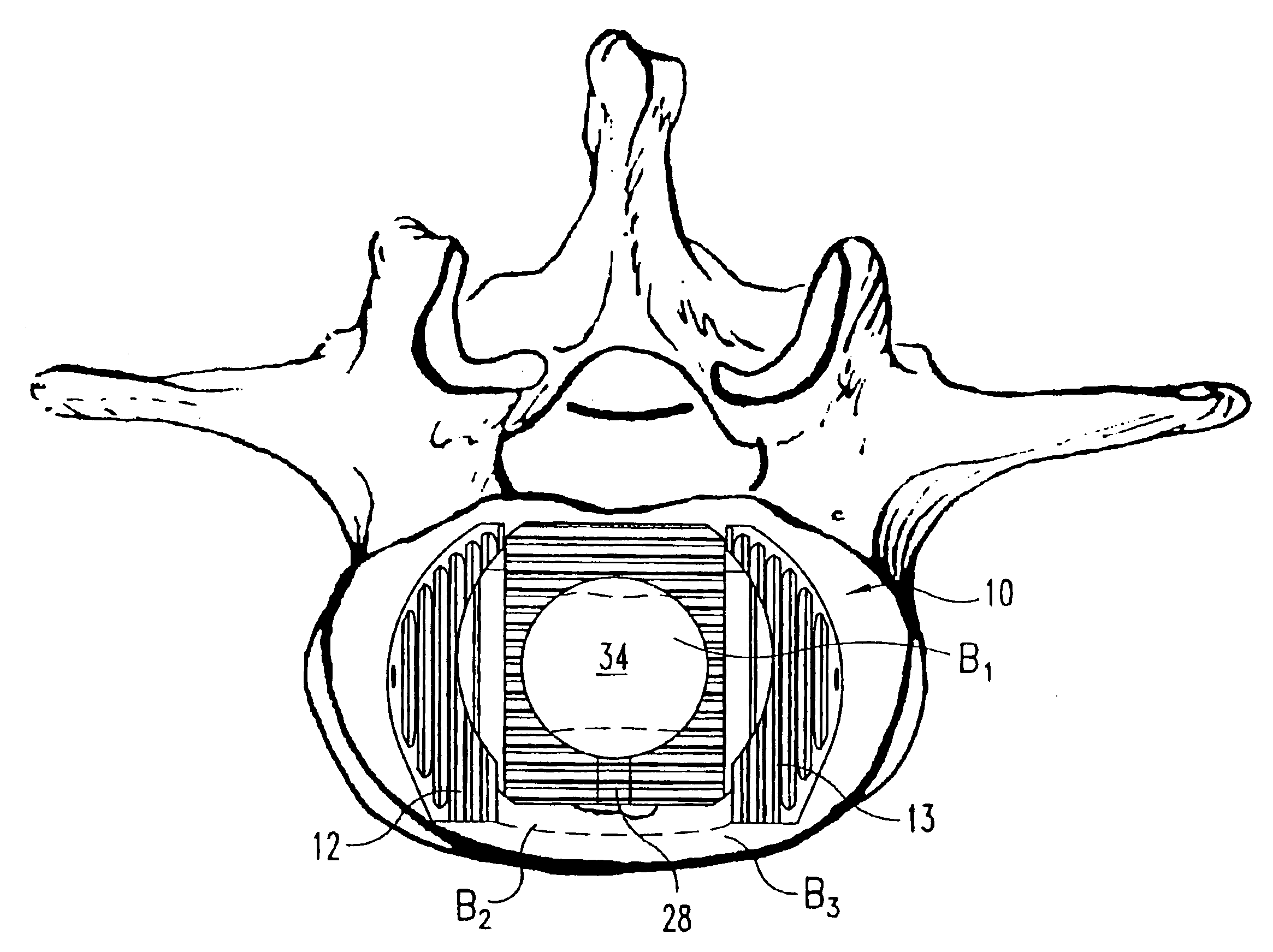 Modular interbody fusion implant