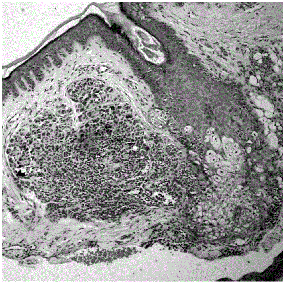 Deep learning-based skin biopsy image pathological characteristic recognition method