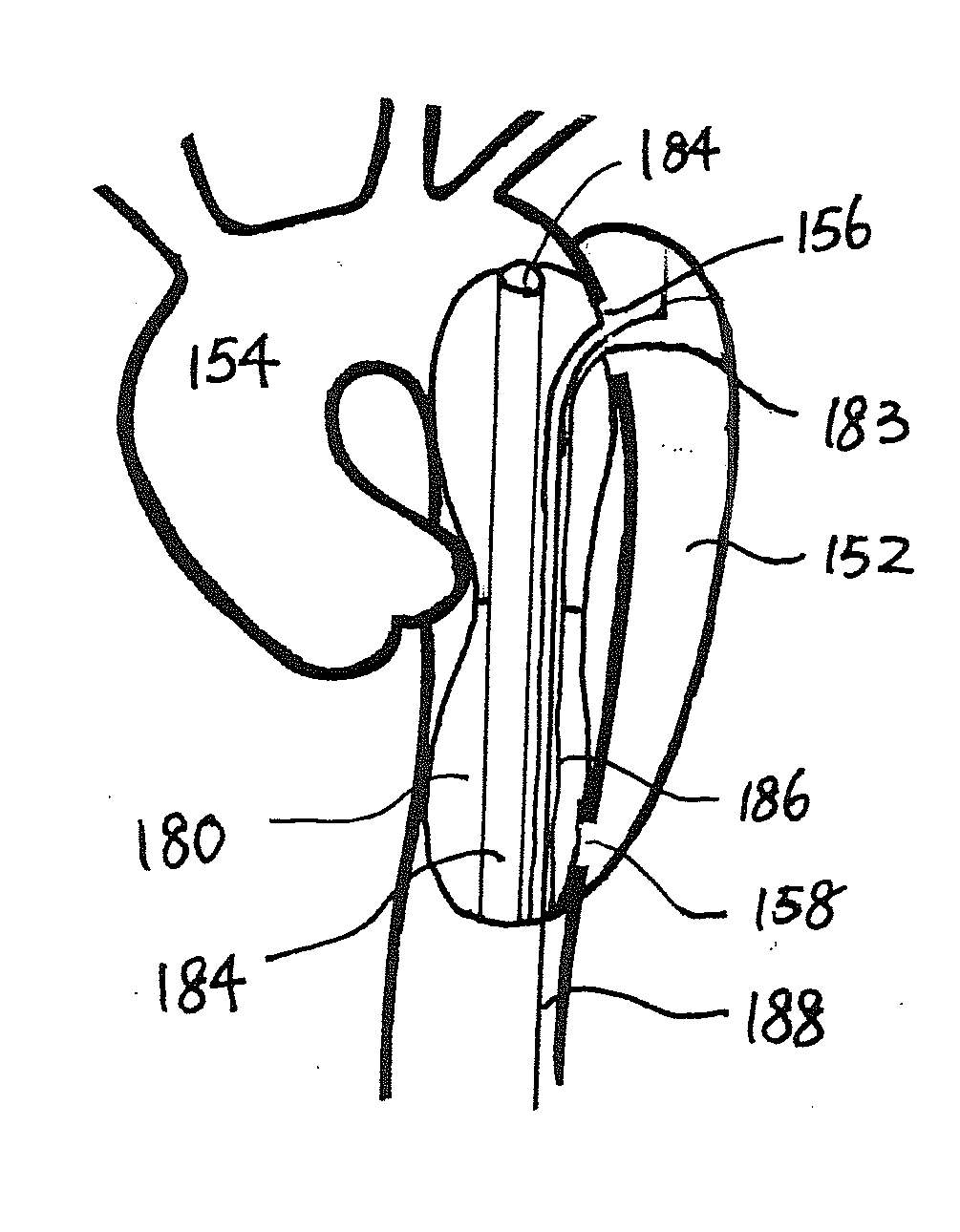 Devices, therapeutic compositions and corresponding percutaneous treatment methods for aortic dissection