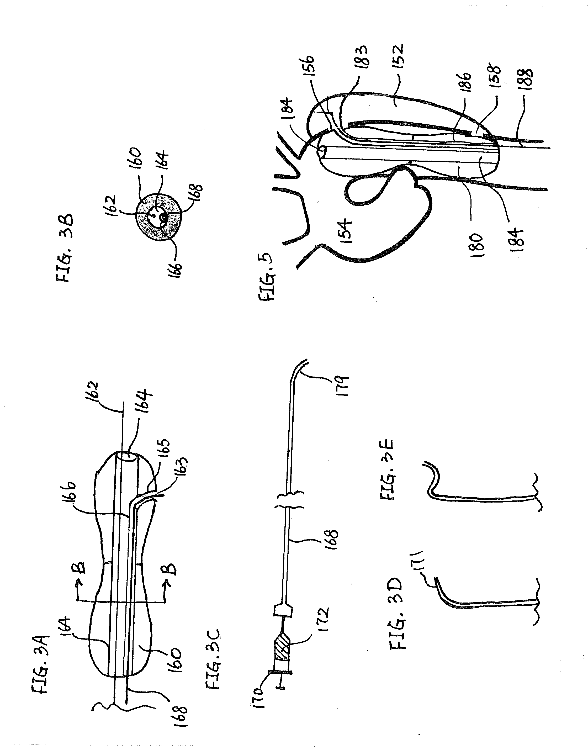 Devices, therapeutic compositions and corresponding percutaneous treatment methods for aortic dissection