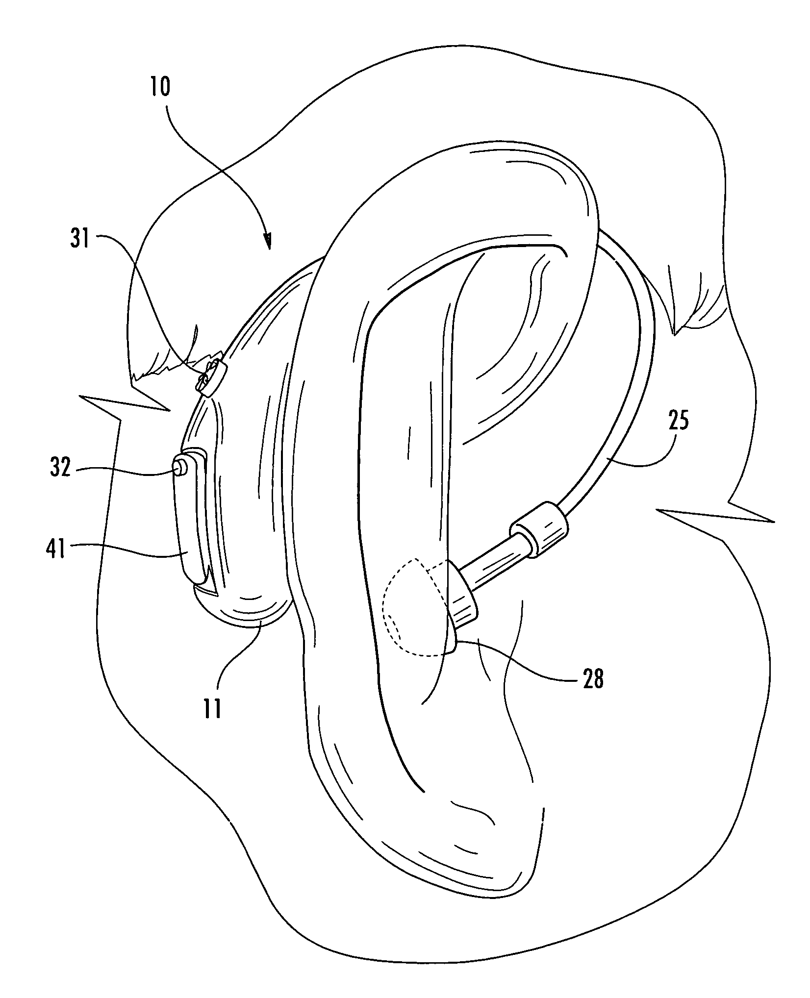 Behind-the-ear hearing aid with integrally-molded instrument case