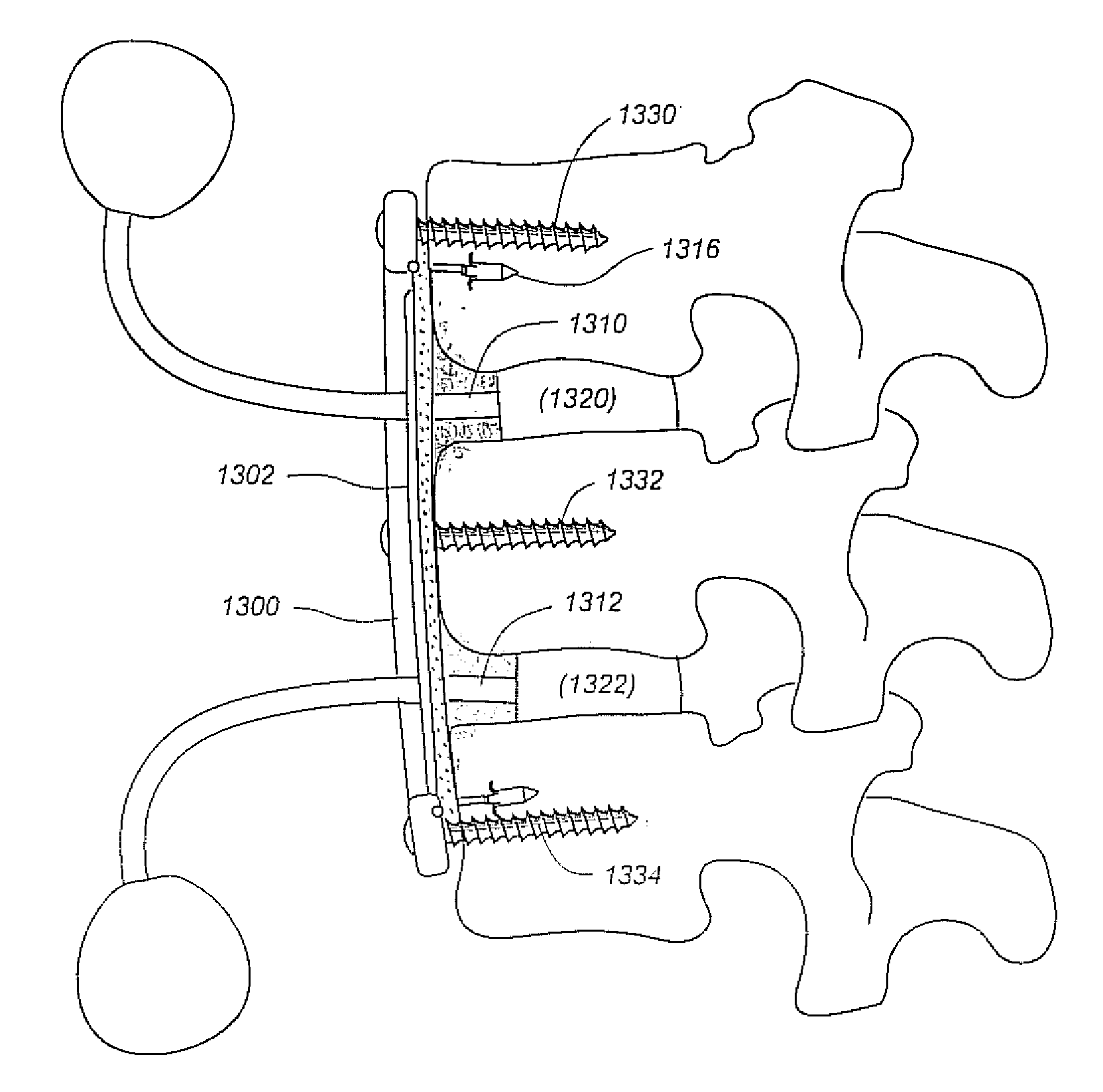 Methods and apparatus for repairing and/or replacing intervertebral disc components and promoting healing